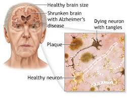 Alzheimer's